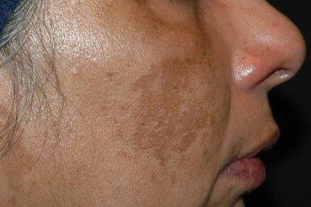 Before treatment
